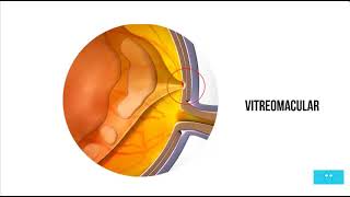 Revised Vitreomacular Traction  - Mr Mahi Muqit PhD FRCOphth