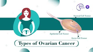 Types of Ovarian Cancer I Dr. Sampada Dessai I Gyne Oncologist I Mumbai