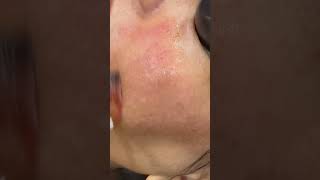 Face Peel for pigmentation #melasma #pigmentationsolution