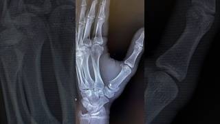 In Shaa Allah Will Be Back Soon After Injury #Cricket #Brokenthumb #supportnewyoutuber