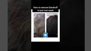 Dandruff removal in one wash home remedies hair care tea tree oil coconut oil ketoconazole shampoo