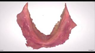 Fast scanning of edentulous mandibular arch