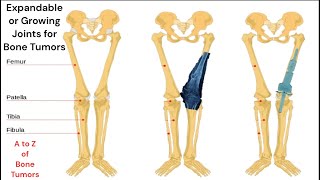 हाडांच्या कर्करोग असलेल्या मुलांसाठी विस्तारण्यायोग्य /वाढणारे सांधे Growing Expanadable Joints
