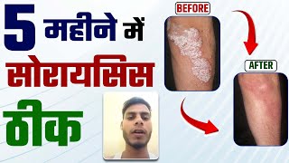 सोरायसिस हुआ 5 महीने में ठीक  | Psoriasis cure | Treatment of psoriasis | psoriasis skin disease