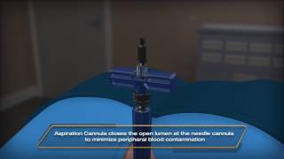 Marrow Cellution - Bone Marrow Harvesting without the need for centrifugation