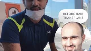 Hair transplant surprising results