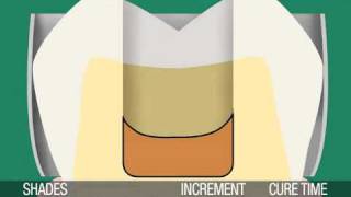 3M ESPE ● Posterior Restorations — Single-Shade Technique