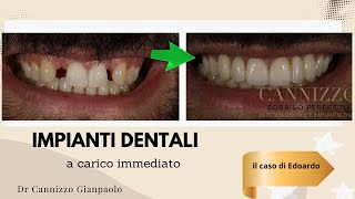 Un caso di impianto dentale a carico immediato eseguito perfettamente - Studio Dentistico Cannizzo