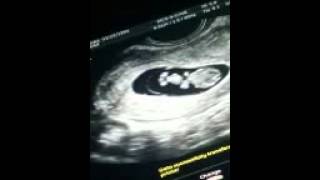 8 week ultrasound