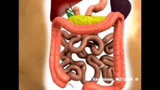 Gastric Bypass to Duodenal Switch