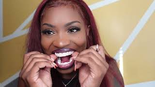 Shiny Smile Veneers: Must Try This Hack!