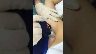 Laser Hair Removal Underarms