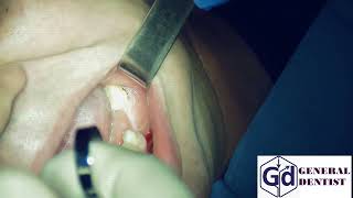 Alveolar inferior nerve block for implantation 35,36.