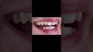 CROWNS AND VENEERS BEFORE AND AFTER | DENTAL IMPLANTS | SMILE DESIGN TURKEY | DENTIST TURKEY |