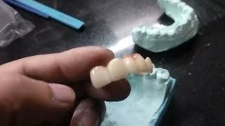 my first vlog viral kaise kare #dental #viral #vlog dant kaise lagate Hain #zirconia