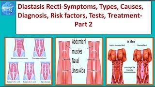 Diastasis Recti Symptoms, Types, Causes, Diagnosis, Risk factors, Tests, Treatment Part 2