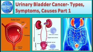 Urinary Bladder Cancer- Types, Symptoms, Causes Part 1