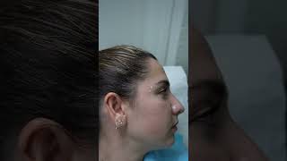 Get Youthful Looking Skin with Forehead Botox by Dr. Olivera Nikolic