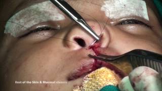 Primary Rhinoplasty in unilateral CL/P: 3-Key suture technique