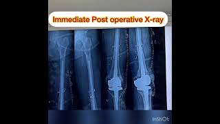 Cryosurgery  in Bone cancer (Osteosarcoma)