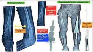 વધતા સાંધાવાળા Expanadable Joint બાળકો માટે નવીનત બોન ટ્યુમર કેન્સર સર્જરી