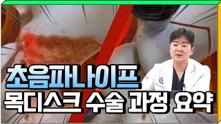 7분요약! 초음파나이프 목디스크수술 과정 (feat 경추수술 전문가)