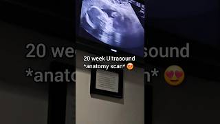 20 week Ultrasound 😍 anatomy scan #pregnancy #ultrasound #20weeks #anatomyscan #pregnant  #girlmom