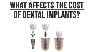 Dr. Blaeser describes what goes into the cost of dental implants