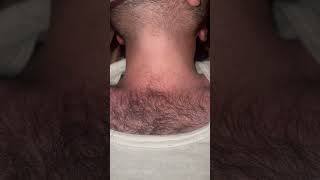 Ingrown hairs vedio t