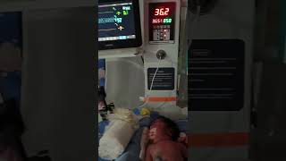 baby in ventilator #venti #nicubaby #nicu #cpaptherapy #sick