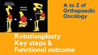 Rotationplasty Surgery