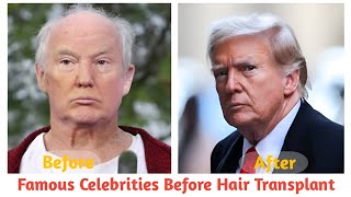 Famous Celebrities Before Their Hair Transplants: 😮 A Shocking Transformation! || hair transplant