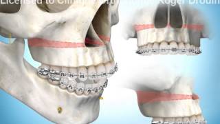 Correction occlusion ouverte par chirurgie