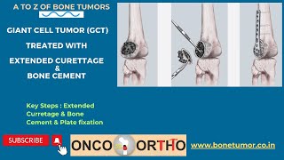 Extended Curettage  Surgery with Plate fixation and Bone cement for Giant cell tumor (GCT) of Bone