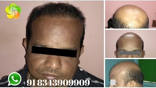 FUE Hair Transplant | Before-After | Patient Review | +91-8343909909