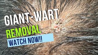 Live video of wart removal at Dermosphere Clinic