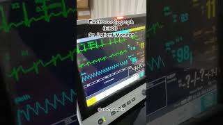 How to install Patient Monitor ECG #elektromedik #tech #health #biomedicalengineering #doctor #ecg