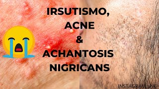 IRSUTISMO, ACNE, ACHANTOSIS NIGRICANS: i 3 problemi dermatologici principale della PCOS | clamoroby