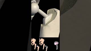 Hip replacement surgery 3D Animation video #shorts