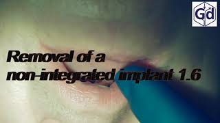 Removal of a non integrated implant 1. 6.