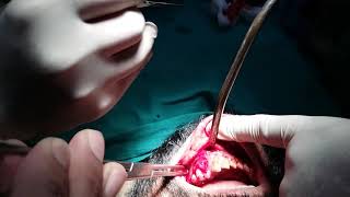 Biopsy taking from lower jaw of a patient