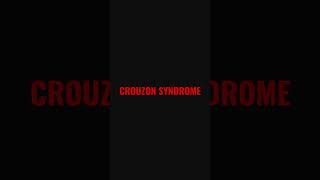 crouzon syndrome