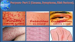 Purpura Part 2 Causes, Symptoms, Risk Factors