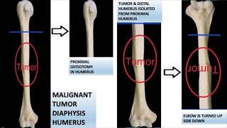 Pedicle Frozen or Cryosurgery or Liquid Nitrogen Surgery for Humerus or Arm bone tumors