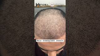 Hair transplant result at Padra Clinic Dubai. #hairtransplant #hair #haircut #hairclinic #hairstyle