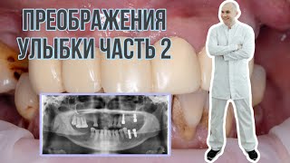 #нкр #одномоментнаяимплантация  #osstem Преображение улыбки часть 2. Работа с оголенными резцами.