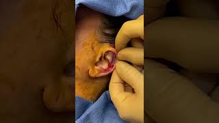 Patient Journey: Ear Pinning Plastic Surgery Transformation