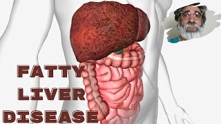 Fatty Liver Disease: Unseen Risks