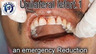 Lefort.1 fracture reduction