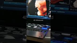 Baby face in 4D ultrasound